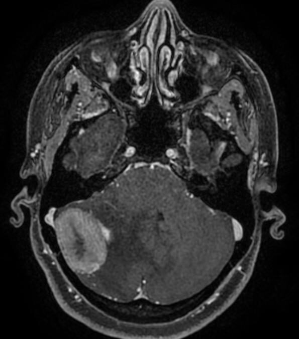 في عملية نوعية لحامل في الشهر الخامس ..”مركزي” القطيف ينقذ حياة مقيمة باستئصال ورم في الدماغ مع الحفاظ على الحمل